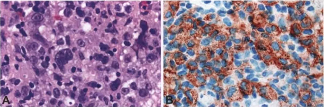Fig. 14.06 Histiocytic sarcoma. A Large, highly pleomorphic histiocytic tumour cells with irregular nuclei and prominent nucleoli. B The lineage-specific marker CD163 was diagnostic in this high-grade neoplasm. 