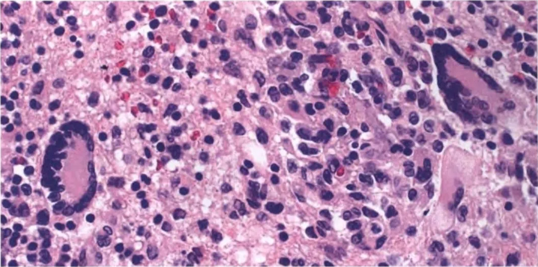 Fig. 14.05 Juvenile xanthogranuloma. Note numerous histiocytic cells and two large multinucleated Touton cells. 