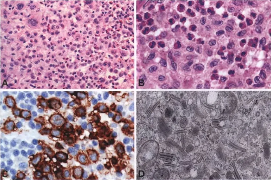 Fig. 14.02 Langerhans cell histiocytosis. A Mixed infiltrate composed of histiocytes, lymphocytes, eosinophils, and multinucleated cells. B The nuclei of Langerhans cells are typically slightly eccentric, ovoid, and reniform or convoluted, with linear grooves and inconspicuous nucleoli. C CD1a expression by neoplastic Langerhans cells. D Electron microscopy showing characteristic rod-shaped structures (Birbeck granules). 