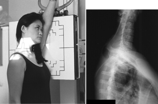 A 5-degree caudal tube tilt may help to separate the shoulders and reduce superimposition of surrounding anatomy. This view may be used when C6-C7 cannot be visualised on the lateral cervical view.