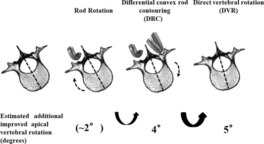 Dynamic schema of apical vertebral body rotation with each surgical method. Estimated additional improvement in apical vertebral rotation was 4° after DRC, and 5° after DVR.