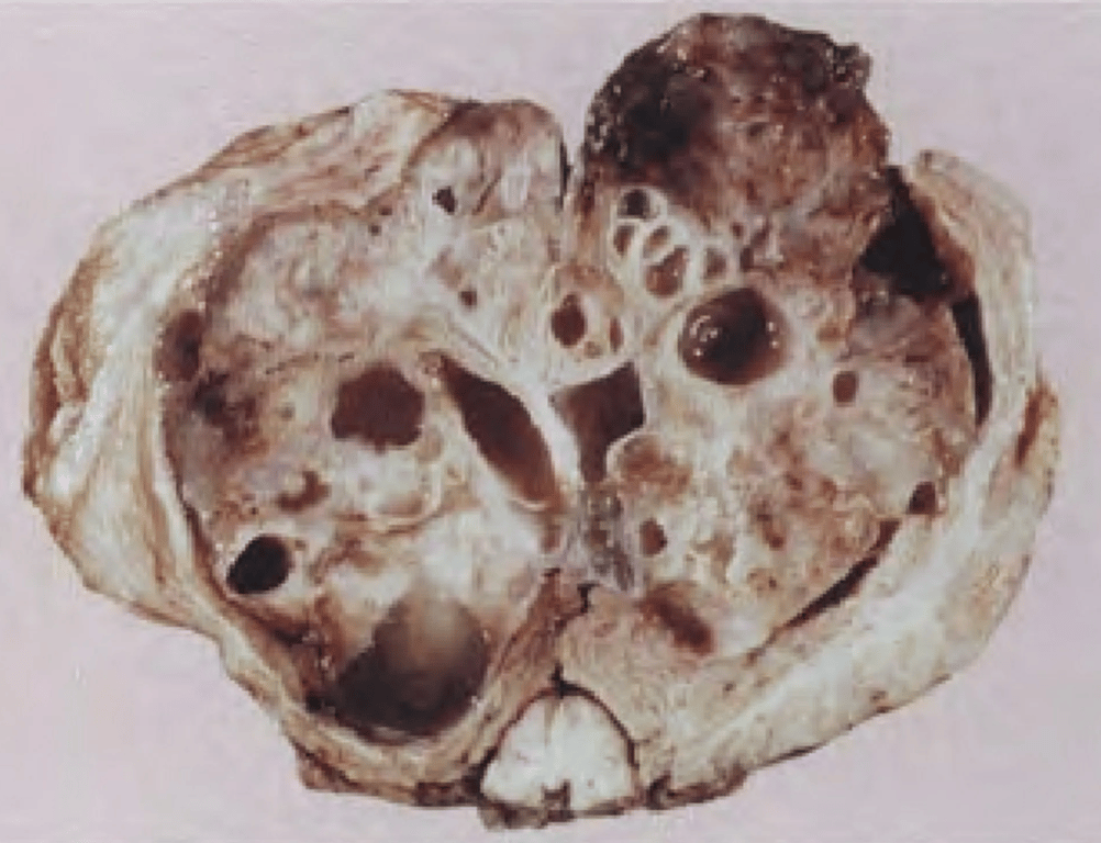 Large immature teratoma of the cerebellum in a 4-week-old infant, with characteristic cysts and chondroid nodules. 