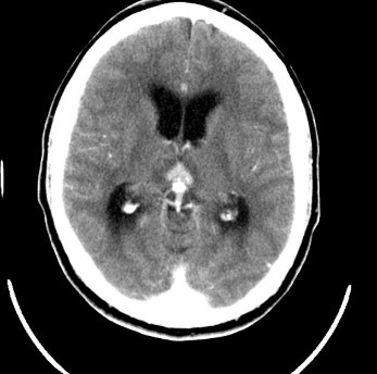 A close-up of a brain scan AI-generated content may be incorrect.