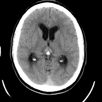 A close-up of a brain scan AI-generated content may be incorrect.