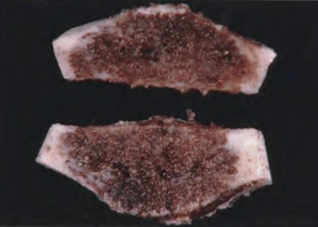 Capillary haemangioma. Reddish-brown sponge-like appearance of an intraosseous capillary haemangioma on cut surface of a skull resection specimen. 