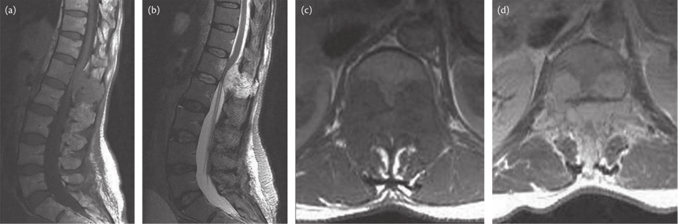 Haemangioma. Exophytic mass affecting posterior aspect of vertebral bodies and posterior elements is shown on T1 (A) and T2 (B) sagittal MRI (arrows). Axial MRI before (C) and after (D) contrast show intense enhancement of the haemangioma with substantial compression of the thecal sac (arrows).