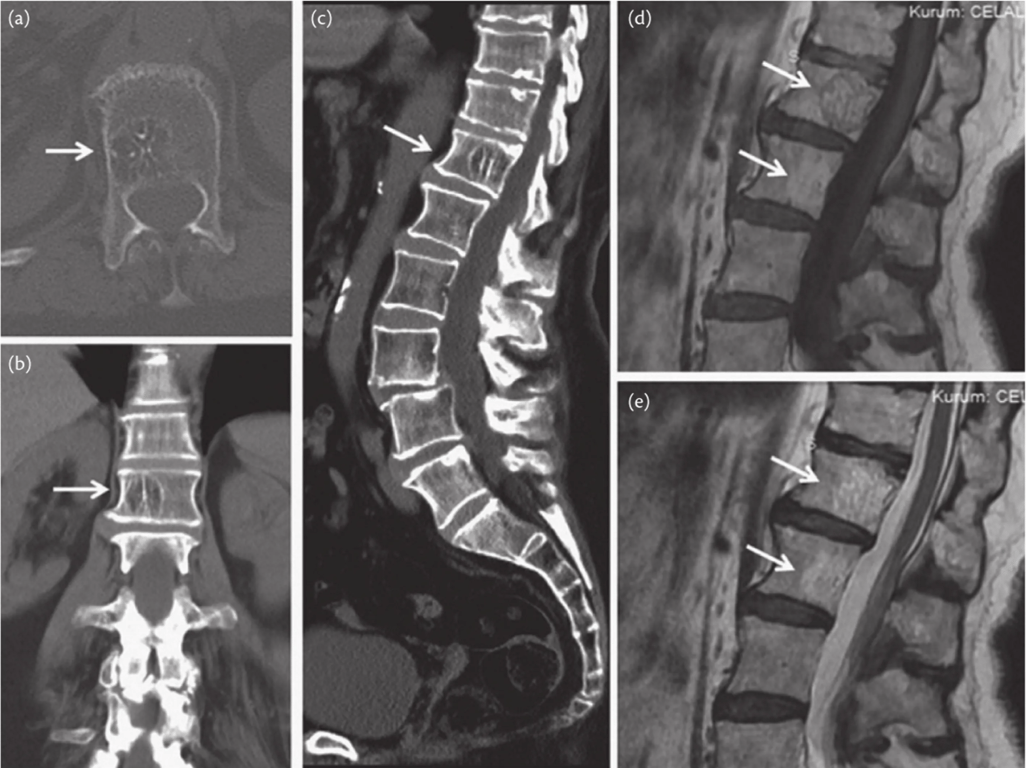 Haemangioma. (A) Axial computed tomography (CT) scan image showing multiple punctate areas of sclerosis creating the white polka-dot sign. (B) Coronal and (C) sagittal reconstructed CT images displaying prominent vertical trabecula of corpus of the D12 vertebra resembling a honeycomb and forming the ‘corduroy’ sign. (D) Sagittal T1-weighted and (E) sagittal T2-weighted magnetic resonance images demonstrating two haemangiomas at the D12 and L1 vertebrae with high signal intensity (arrows).