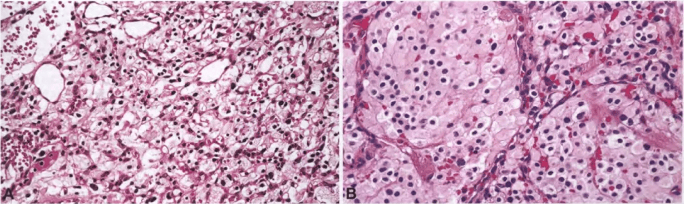 Machine generated alternative text: Fig. 11.14 Haemangioblastoma. A Stromal cells with clear, vacuolated cytoplasm due to accumulation of lipid droplets. B The cellular variant is a closer mimic of metastatic renal cell carcinoma and is characterized by cohesive nests of epithelioid stromal cells, with less-vacuolated cytoplasm and fewer intervening capillaries. 