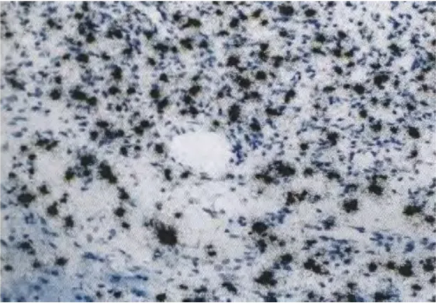 Haemangioblastoma. VEGF mRNA expression in stromal cells. 