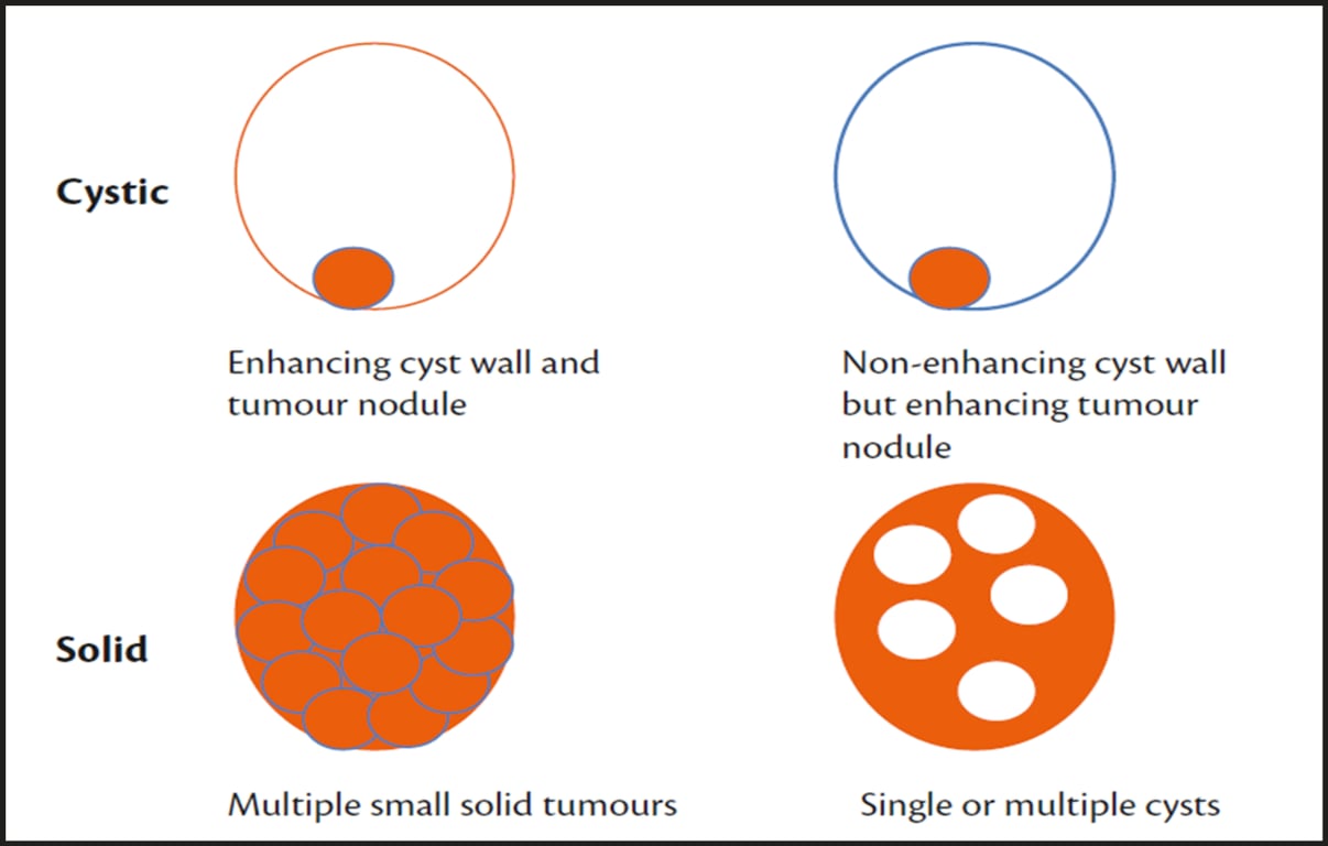 Cystic Enhancing cyst wall and tumour nodule Solid Multiple small solid tumours Non-enhancing cyst wall but enhancing tumour nodule Single or multiple cysts 