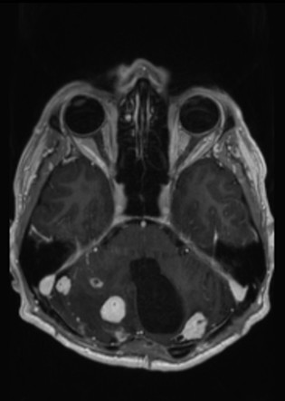Multiple lesion for VHL-associated