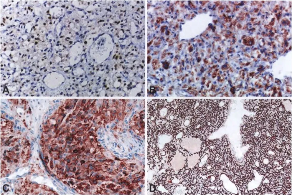 Haemangioblastoma. (A) Nuclear expression of HIF1A in stromal cells. (B) Immunostaining for inhibin highlights the stromal cells. (C) Unlike in metastatic renal cell carcinoma, the tumour cells of this cellular haemangioblastoma are inhibin-positive. (D) CD34 immunostaining highlights the rich vascular network, whereas intervening stromal cells are negative.