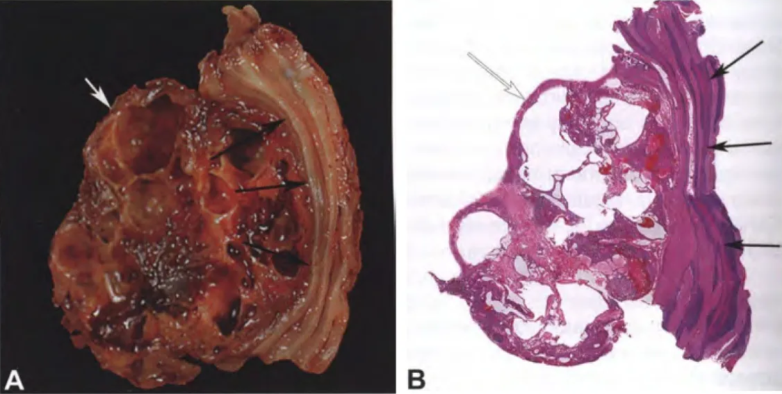 Machine generated alternative text: Fig. 11.11 Haemangioblastoma. A,B The tumour is multicystic (white arrow) and well demarcated from the surrounding cerebellum (black arrows). 