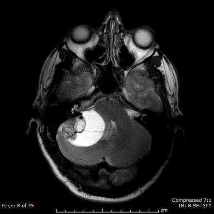 Cystic nature of the mural nodule
