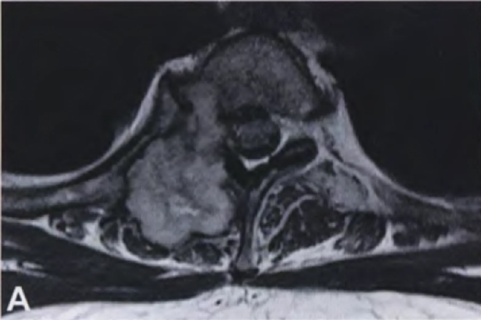 Chondrosarcoma. (A) MRI of a low-grade chondrosarcoma arising from the vertebral column. Note the lobulated contours and invasion into adjacent soft tissues.