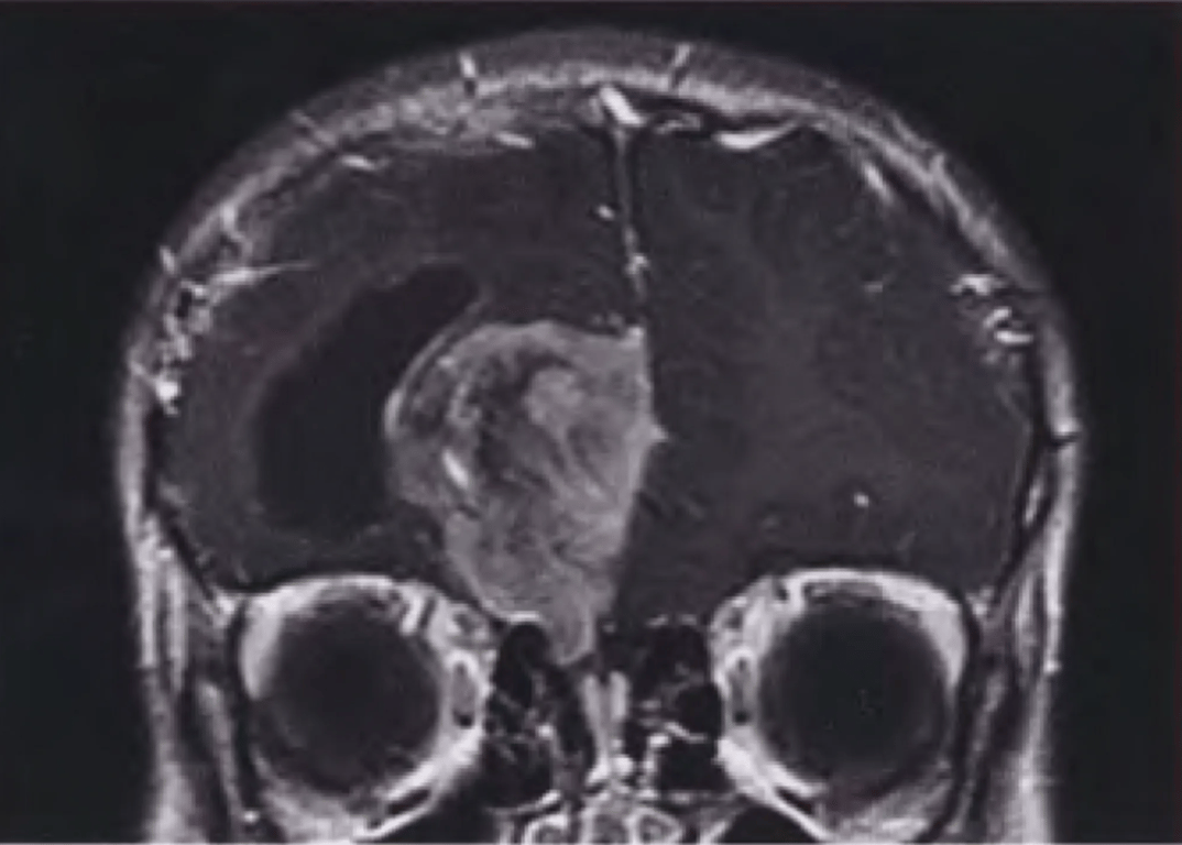Postcontrast T1-weighted MRI of a dural-based Ewing sarcoma / peripheral primitive neuroectodermal tumour mimicking meningioma.