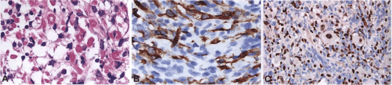 Meningeal rhabdomyosarcoma. (A) Rhabdomyoblasts are evident in this primitive-appearing meningeal tumour from a child. (B) Desmin positivity highlights the rhabdomyoblasts. (C) Extensive myogenin immunoreactivity.