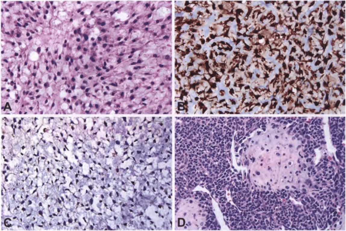 Chondrosarcoma. 
(A) Low-grade chondrosarcoma may show small stellate to epithelioid cells set within a myxoid background, overlapping morphologically with chordoma. 
(B) S100 immunoreactivity is typically strong in low-grade chondrosarcomas, but is not very specific, because it may also be seen in other diagnostic considerations, such as chordoma. 
(C) Lack of nuclear brachyury expression helps distinguish chondrosarcoma from chordoma. 
(D) The combination of a small blue cell tumour with well-formed hyaline cartilage is characteristic of mesenchymal chondrosarcoma.