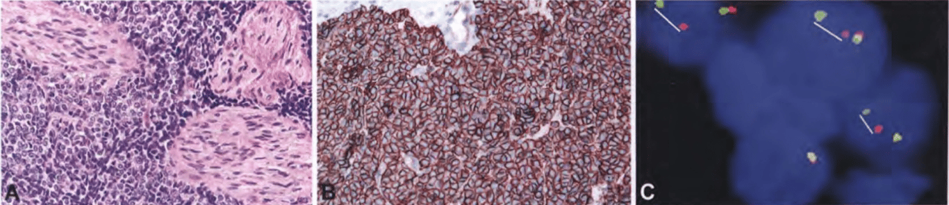 Ewing sarcoma / peripheral primitive neuroectodermal tumour. (A) Invasion of nerve roots. (B) Diffuse membrane immunoreactivity for CD99. (C) FISH results positive for EWSR1 (EWS) gene rearrangement, with split of paired red and green signals (white lines).