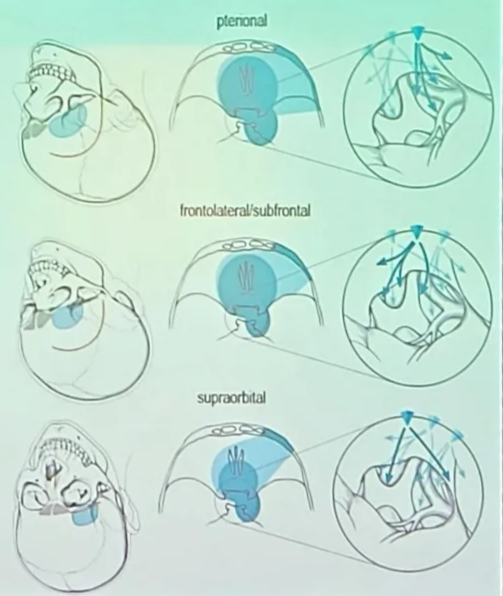 The Transcranial Approach to TSM lateral (pterional, frontolateraVsubfrontal, supraorbital) • mecfial Onterhemispheric frontobasal or superior) • Uni- or bilateral? • Bilateral subfrontal • preservation of blood supply improved • Transection of SSS has risk of venous infarction • Risk of anosmia • Risk of CSF leak due to frontal sinus opening Unilateral subfrontal • • Less morbidity and adequate results • Ipsi- or contralateral to worsened vision? Non-dominant approach • • Ipsilateral for early decompression of ON Contralateral for better visualization of inferomed ON, • but worse visualization of lateral affected ON • Side of vascular encasement ot Graz ptenonal frontolateral'subfrontal supfinbltal 