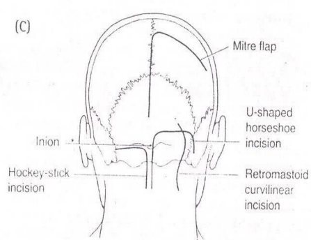 (C) Inion Hockey-stick incision Mitre flap U-shaped horseshoe incision Retromastoid curvilinear incision 