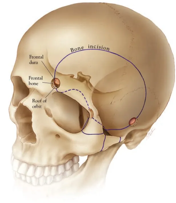 Bone incision Frontal dura Frontal of orbit Fig. 26.6 The placement of entry holes and osteotomies for the orbitocranial zygomatic approach to the anterolateral skull base is illustrated. The extent of the bone opening is individually tailored by addinq or omittinq various portions of this approach. All fiqures 
