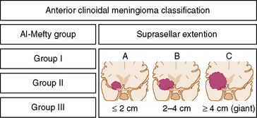 Anterior clinoidal meningioma classification Al•Mefty group Group I Group Il Group Ill Suprasellar extention B c > 4 cm (giant) 