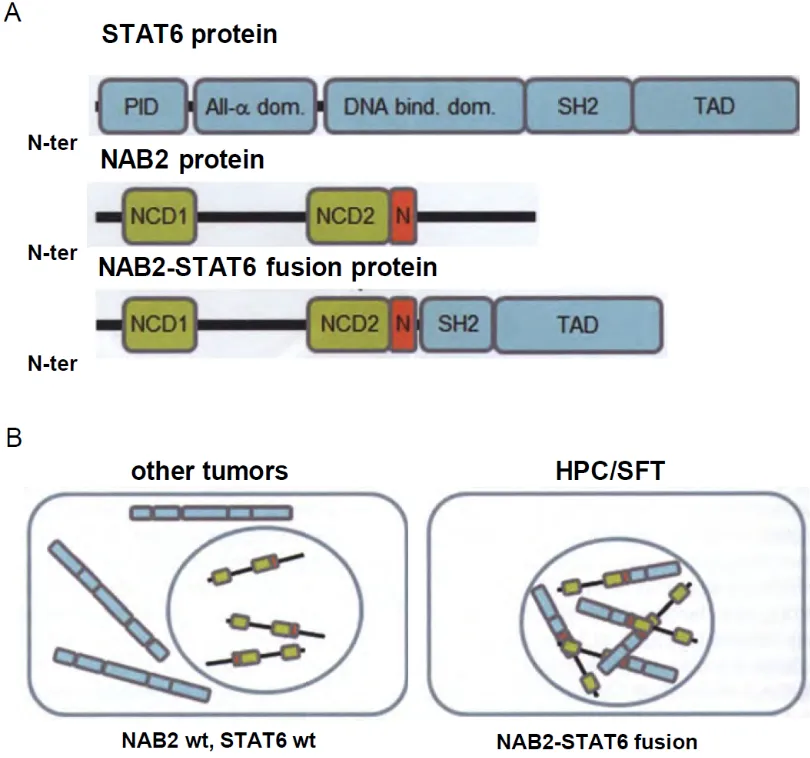 STAT6 protein PID N-ter All-a dom. DNA bind. dom. NCD2 SH2 TAD TAD NAB2 protein NCDI N-ter NAB2-STAT6 fusion protein NCDI N-ter other tumors NAB2 wt, STAT6 wt NCD2 N SH2 HPC/SFT NAB2-STAT6 fusion Fig. 11.09 Solitary fibrous tumour / haemangiopericytoma (HPC/SFT). A The break point in STAT6 varies, but is within or N-terminal to the SH2 domain. The break point in NAB2 also varies, but is usually C-terminal to the nuclear localization sequence (N). B Preservation of the NAB2 nuclear localization signal results in nuclear localization of the fusion protein {2308}. All-a dom., all-alpha domain; DNA bind, dom., DNA-binding domain; NCDI, NAB-conserved domain 1; NCD2, NAB-conserved domain 2; N-ter, N-terminus; PID, protein interaction domain; SH2, SRC homology domain; TAD, transcriptional activator domain; wt, wildtype. 
