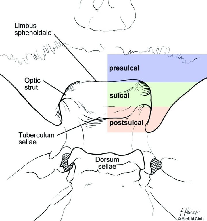Limbus sphenoidale Optic strut Tuberculum Qf'Q4 presulcal su cal postsul al Dorsum sellae @ Mayfield Clinic 