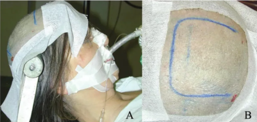 A 45-year-old female with a history of headaches and recent onset of mild left hemiparesis. Magnetic resonance imaging showed a right extraaxial parasagittal contrast-enhancing mass partially invading the middle third of the SSS. (A) The patient is positioned in a semisitting fashion. (B) Right frontoparietal horseshoe skin incision extending 1.5/2 cm across the midline.