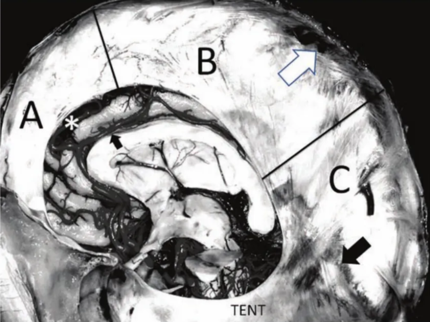 TENT Fig. 17.1 Photograph of anatomical specimen identifying the anterior (A), middle (B), and poste- rior (C) portions of the falx. Visible are the superior sagittal sinus (white arrow) and the straight sinus (block arrow). The tentorium (TENT), pericallosal artery (small arrow), and callosomarginal artery (asterisk) are also seen. 