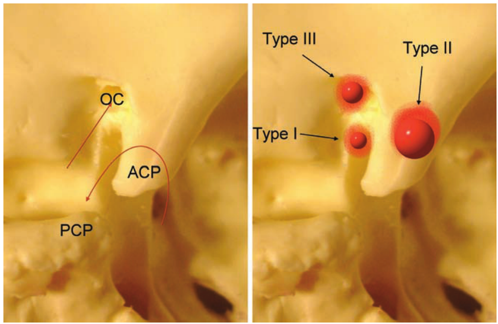 Bony anatomy of the anterior clinoid process region. (Left) The course of the optic nerve (straight arrow) and the course of the internal carotid artery (curved arrow). OC, optic canal; ACP, anterior clinoid process; PCP, posterior clinoid process. (Right) The origin of the different types of clinoidal meningiomas.