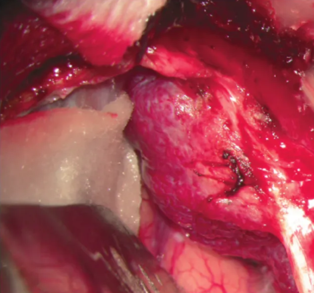 A 33-year-old female with a recent history of transient, short episodes of right body paresthesias and concomitant aphasia. Magnetic resonance imaging showed a left parasagittal contrast-enhancing mass completely obstructing the superior sagittal sinus. An intraoperative photograph shows the exposure of the left aspect of the mass and its dissection from the brain.