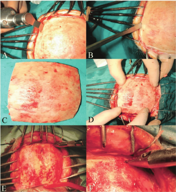 Close-up of a surgery process AI-generated content may be incorrect.