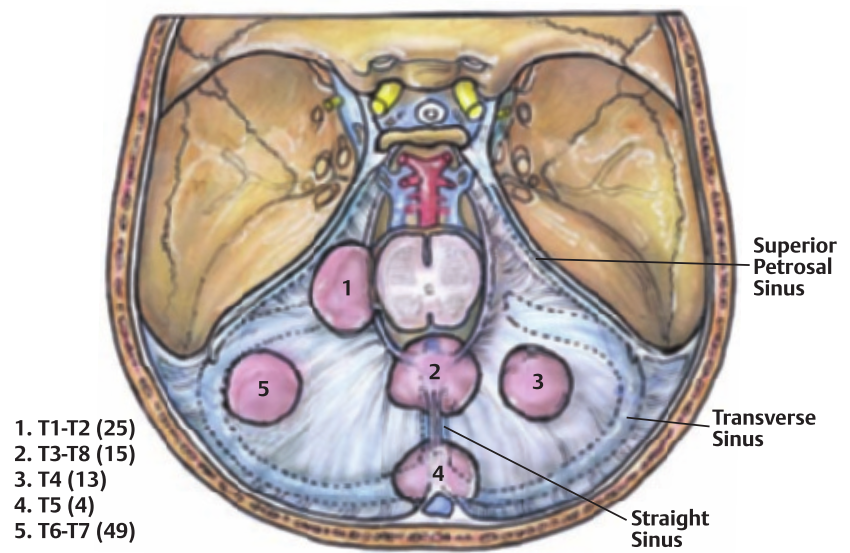 Superior Petrosal Sinus Transverse Sinus 1. Tl-T2 (25) 2. T3-T8 (15) 3. T4 (13) 4. T5 (4) 5. T6-T7 (49) Straight Sinus 