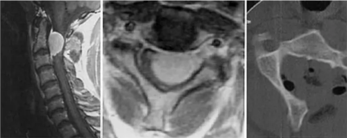 S. N. Misra and H. W. Morgar Fig. 5. Case 2. Preoperative sagittal (left) and axial (center) MR images demonstrating a posterolateral intraspinal meningioma. Postoperative axial computerized tomography scan (right) illustrating the unilateral Al approach for the dura-splitting excision of the entire lesion. 
