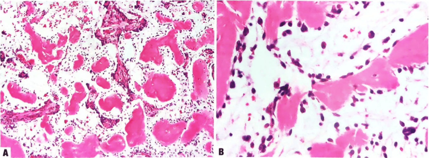 (A) Tumour cells embedded in loose, pale basophilic myxoid matrix with dispersed heavily collagenized material. 
(B) Small to medium-sized oval to spindled and epithelioid cells.
