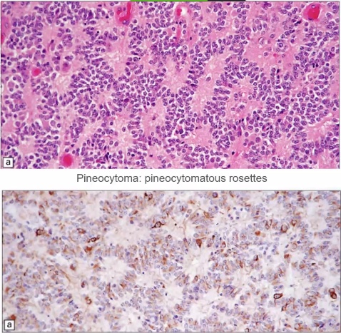 Pineocytoma: pineocytomatous rosettes 