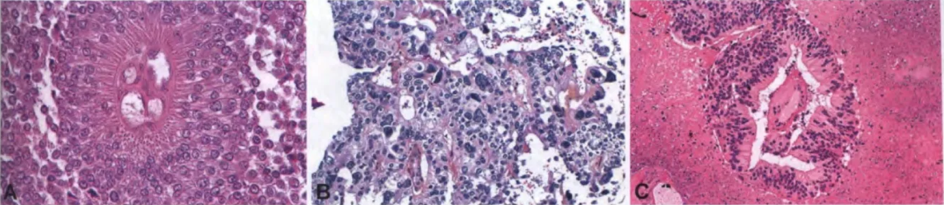 Fig. 7.20 Papillary tumour of the pineal region. A The vascular axes of neoplastic papillae often harbour multiple B In some tumours, bizarre pleomorphic cells are observed; this nuclear atypia is more dystrophic in nature than related vascularized core, leading to an apparent clear perivascular space. Note the e)densive necrosis. capillaries, resulting in a pseudoangiomatous appearance. to anaplasia. C Neoplastic cells detached from the papillary 