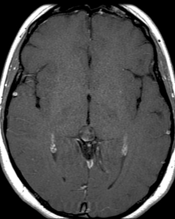 A close-up of a brain scan AI-generated content may be incorrect.