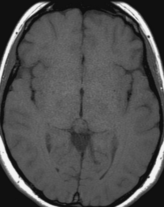 A close-up of a brain scan AI-generated content may be incorrect.