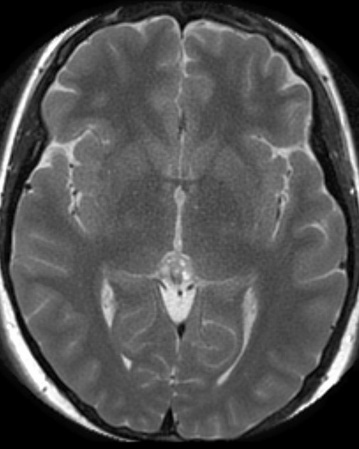 A mri scan of a brain AI-generated content may be incorrect.