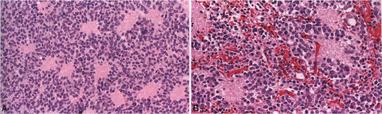 Machine generated alternative text: Fig. 7.04 A Typical pineocytoma. A sheet of tumour cells with scattered pineocytomatous rosettes. B Pineocytoma. Uniform tumour cells resembling pinealocytes. 
