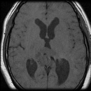 T1-Heterogeneous and mostly hypointense