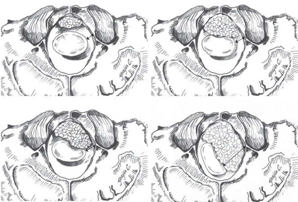 Schematic showing growth of anterior and anterolateral intradural foramen magnum (FM) meningiomas and the development of the surgical corridor. The top left diagram shows the narrow space between the medulla and the bony wall of the FM (double-headed arrow) in a purely anterior FM meningioma. As the tumor enlarges (bottom left), the brain stem is displaced and the corridor widens. Often the patient begins to become symptomatic at this point but is rarely diagnosed until the corridor is widely established (bottom right).