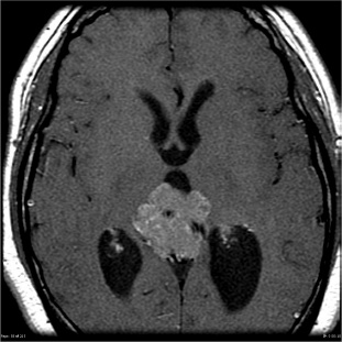 A close-up of a brain scan AI-generated content may be incorrect.