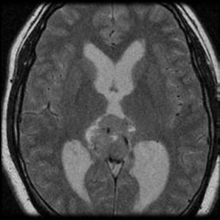 A mri of a brain AI-generated content may be incorrect.