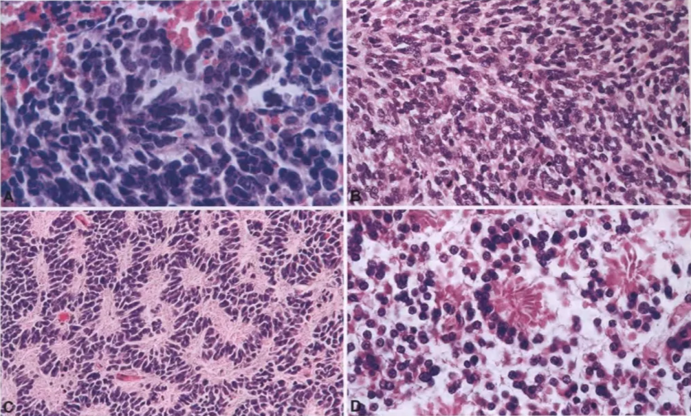 Pineoblastoma. (A) Marked proliferation of undifferentiated neoplastic cells with a high nuclear-to-cytoplasmic ratio. (B) High cellularity with numerous mitotic figures. (C) Homer Wright rosettes. (D) Fleurettes. Fleurettes is a French word for small flower