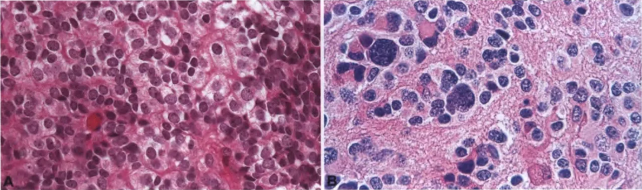 Fig. 7.10 Pineal parenchymal tumour of intermediate differentiation. A Diffuse pineal parenchymal tumour of intermediate differentiation. This tumour is composed of round cells with a conspicuous cytoplasm and round to oval nuclei with delicate chromatin. B Pleomorphic cells in a low-grade pineal parenchymal tumourof intermediate differentiation. 