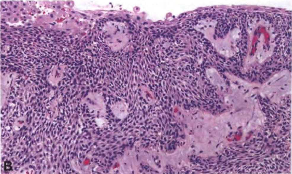 At higher magnification, the lining is consistent with non-keratinizing squamous epithelium.
